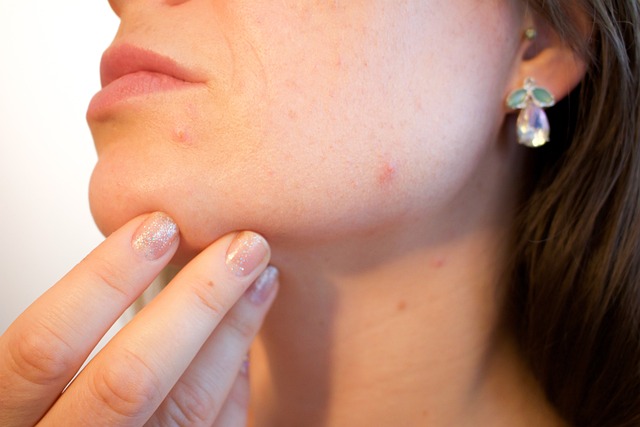 Pimple Body Parts Health Sign Pimple Jaws